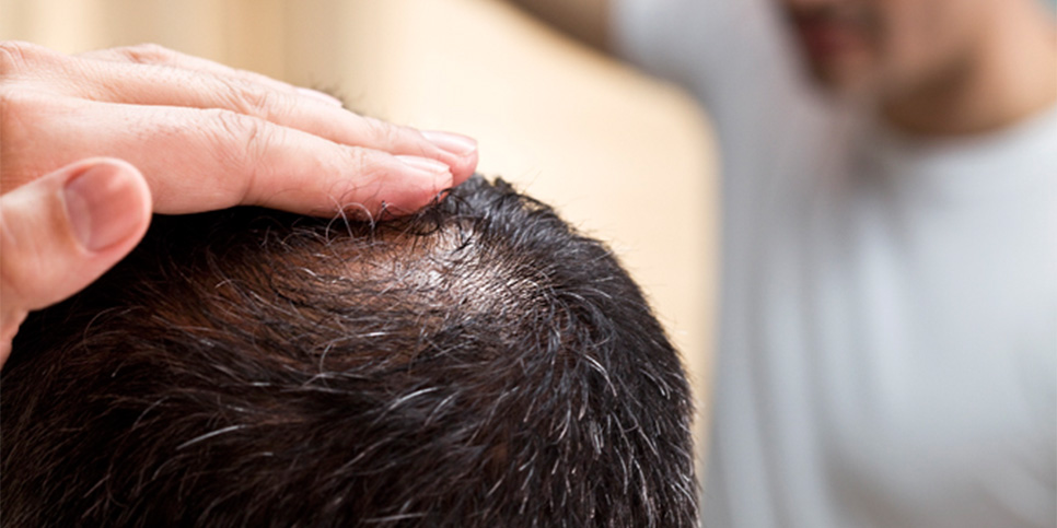 Causes of hair loss in men