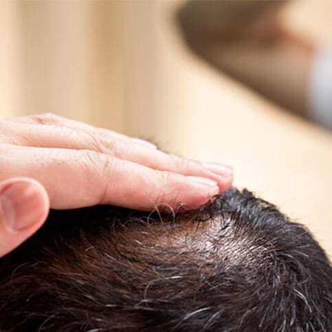About hair loss